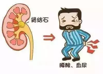 哪些原因會導致腎結石?