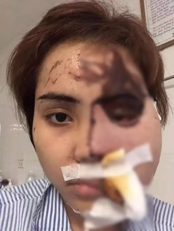 警官綠火中燒！鏹水淋新婚妻子