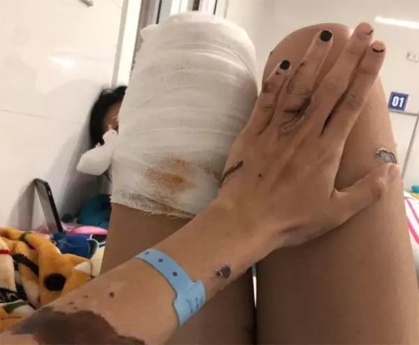 警官綠火中燒！鏹水淋新婚妻子