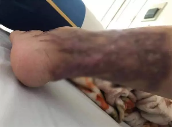 警官綠火中燒！鏹水淋新婚妻子