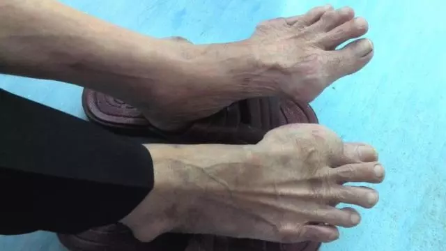 痛風,為什麼腳部最常見?平時注意這4件事,有助於降尿酸