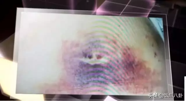 45歲女星兩度流產仍不放棄生娃,做人工受孕被針扎致滿肚淤青