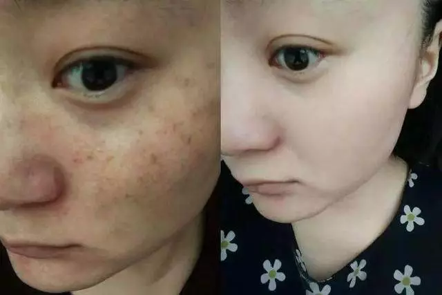 睡前用牙膏加點「它」擦臉,美白淡斑只需十幾分鐘,堅持一周恢復嬰兒肌!