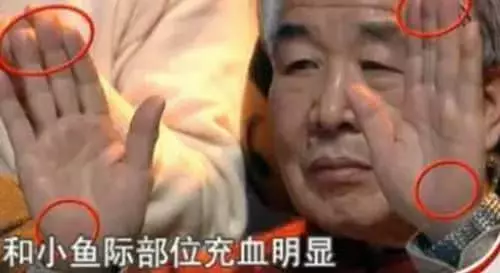 這條糖尿病線,你手上有沒有?不花一分錢,避免截肢、失明!!