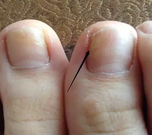 腎好不好,看腳就知道!腳上一旦有「這東西」,腎臟多半已被「挖空」,提示你該養腎了