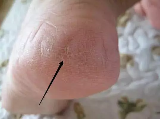 腎好不好,看腳就知道!腳上一旦有「這東西」,腎臟多半已被「挖空」,提示你該養腎了