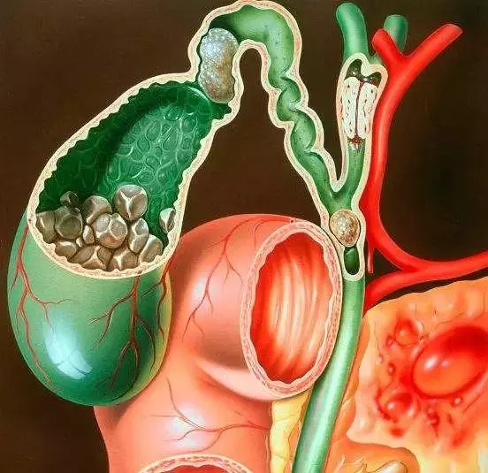 膽囊結石,這顆定時炸彈你必須了解!