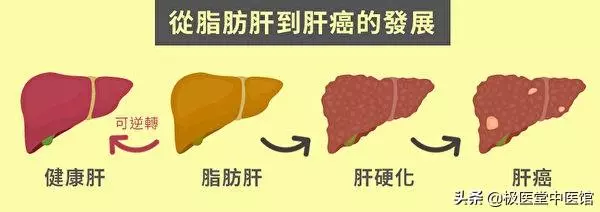 當心脂肪肝變肝癌!5招教你消除脂肪肝秘訣!