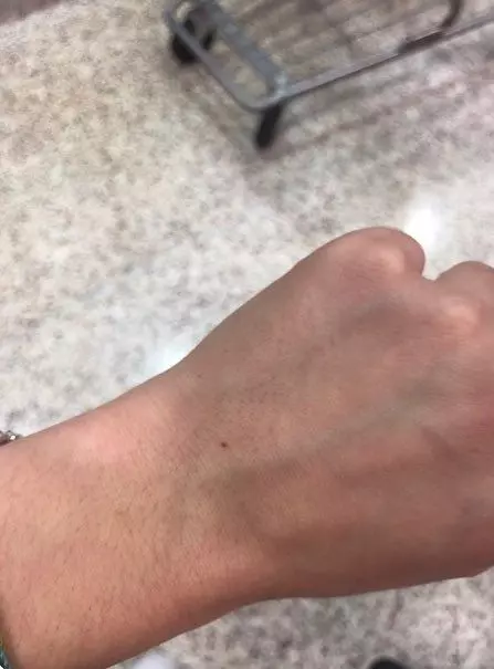手腕這裡長痣!1萬多女生驚訝「我也有」 專家解釋:原因很單純