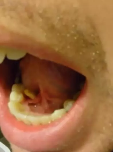 男子舌頭腫脹數日,伸手一擠竟然跑出一條超嚇人的「蟲」?!真是太噁心了!