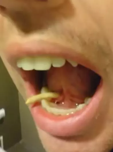 男子舌頭腫脹數日,伸手一擠竟然跑出一條超嚇人的「蟲」?!真是太噁心了!