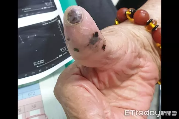 91歲阿嬤洗澡時意外摸到腋下有不明腫塊,檢查後竟是拇指30年黑痣癌變,當場嚇壞!
