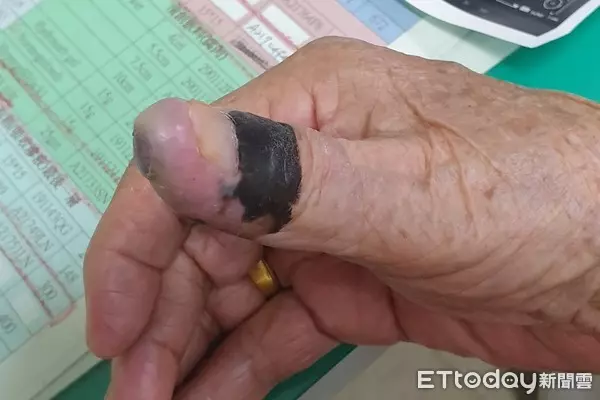 91歲阿嬤洗澡時意外摸到腋下有不明腫塊,檢查後竟是拇指30年黑痣癌變,當場嚇壞!