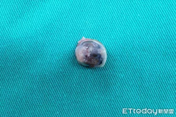91歲阿嬤洗澡時意外摸到腋下有不明腫塊,檢查後竟是拇指30年黑痣癌變,當場嚇壞!