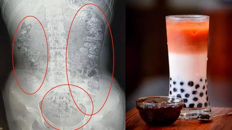 她喝完珍奶便秘5天!醫嚇:腸胃擠百顆圓陰影