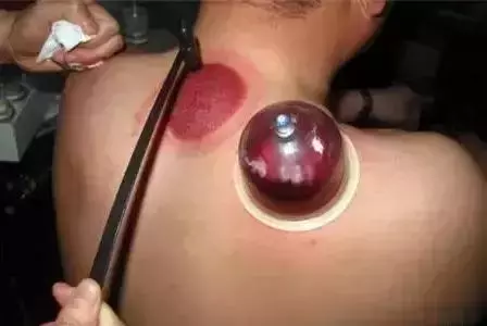 背部刺血竟有如此神奇的功效,可惜少有人知
