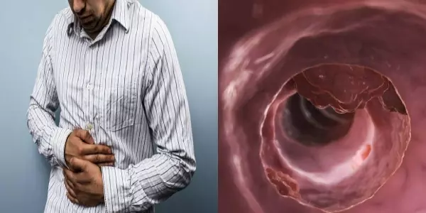 從賀一航看大腸癌! 高發病率通常有「3個共同點」,尤其50歲以上特別注意!