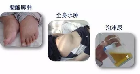 糖尿病腎病嚴重危害健康,早期篩查很重要!做好九點早預防