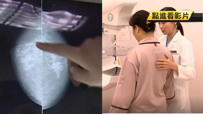 乳癌家族史 25%有遺傳基因突變…3特點曝光