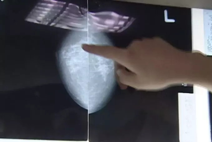 乳癌家族史 25%有遺傳基因突變…3特點曝光