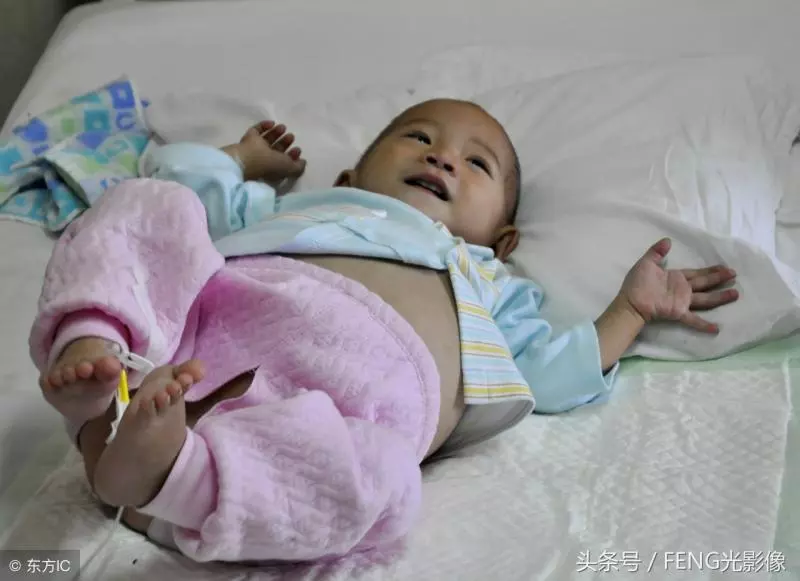 史上最小「孕婦」,因孩子是因寄生胎肚子才變大的,親生父母系全責!