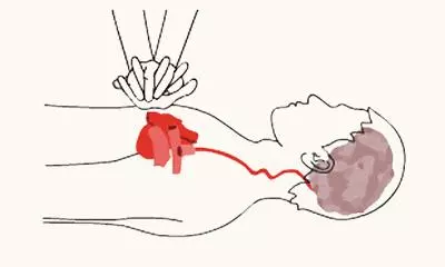 清華學生突發心臟驟停,"續命神器"再立大功!這招可救命!