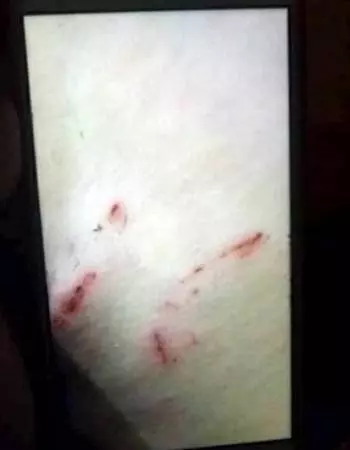 老鼠躲貓貓 鑽入少女褲子 狠咬大腿