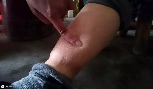 血管堵塞 腳會給你3個信號 別瞎補鈣