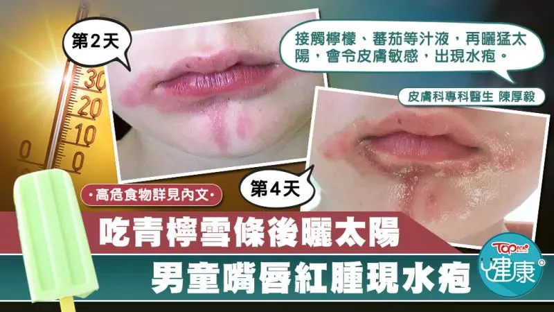 5歲童吃雪條曬太陽嘴唇紅腫現水皰 醫生:患處或痕癢疼痛【附高危食物名單】