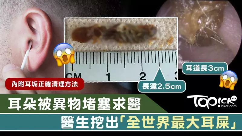 男子耳朵被異物堵塞求醫 醫生挖出2.5cm巨型耳屎塞滿耳道
