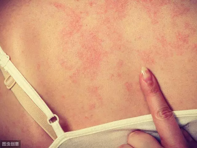 妙齡女子莫名全身瘙癢,跳騷?蚊子?醫生:要避免這3件事