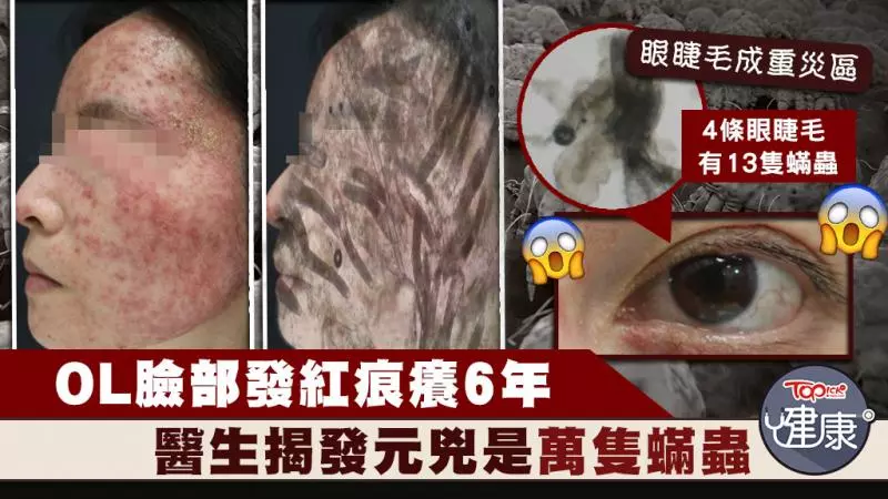 女子臉部痕癢6年揭萬隻蟎蟲作怪 醫生:每1cm²有528隻蟎蟲