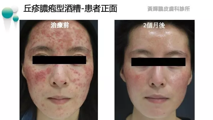 女子臉部痕癢6年揭萬隻蟎蟲作怪 醫生:每1cm²有528隻蟎蟲