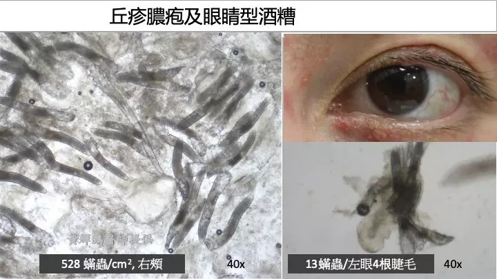女子臉部痕癢6年揭萬隻蟎蟲作怪 醫生:每1cm²有528隻蟎蟲