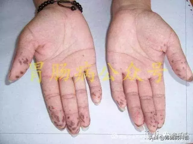 嘴上、手上長黑斑,胃裡、腸里長息肉——這種遺傳病易癌變