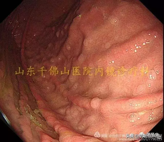 嘴上、手上長黑斑,胃裡、腸里長息肉——這種遺傳病易癌變
