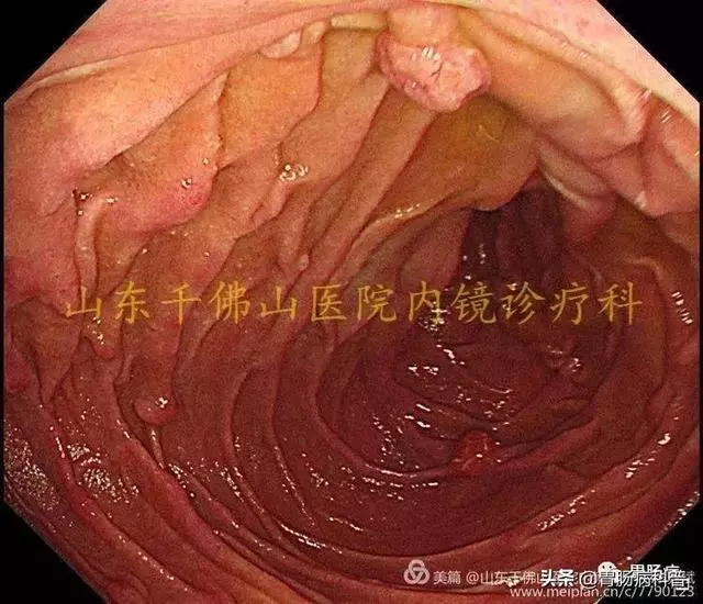 嘴上、手上長黑斑,胃裡、腸里長息肉——這種遺傳病易癌變