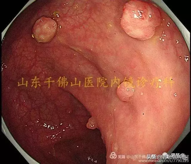 嘴上、手上長黑斑,胃裡、腸里長息肉——這種遺傳病易癌變