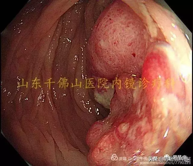 嘴上、手上長黑斑,胃裡、腸里長息肉——這種遺傳病易癌變