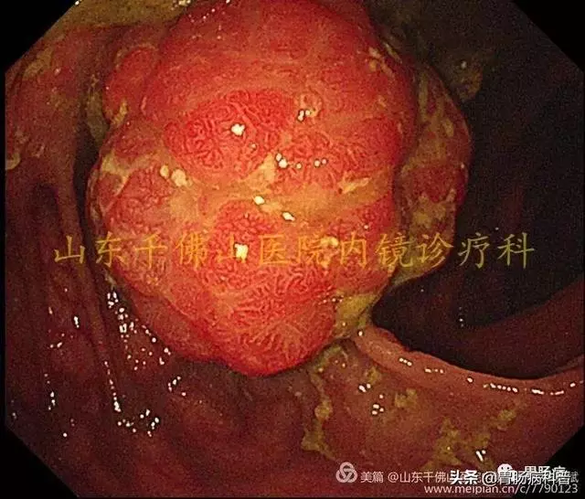 嘴上、手上長黑斑,胃裡、腸里長息肉——這種遺傳病易癌變