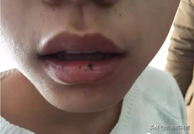 嘴上、手上長黑斑,胃裡、腸里長息肉——這種遺傳病易癌變