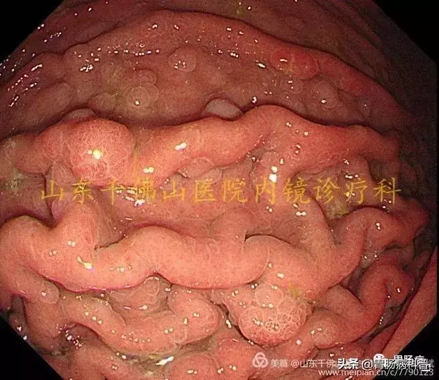 嘴上、手上長黑斑,胃裡、腸里長息肉——這種遺傳病易癌變