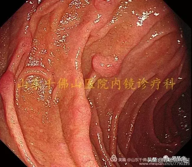 嘴上、手上長黑斑,胃裡、腸里長息肉——這種遺傳病易癌變