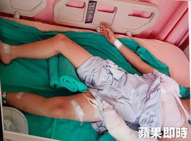 洗手台爆裂 斷8條血管神經 10歲男童受.傷送院急救
