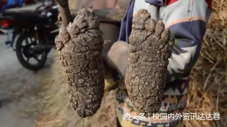 9歲男孩全身「石化」,皮膚一碰就會碎,醫生:治不好,只能等死!