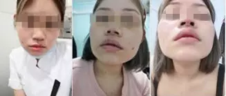 勿貪小便宜!找「微整師」整鼻,還附送「無痕酒窩」 ,結果她中招了!