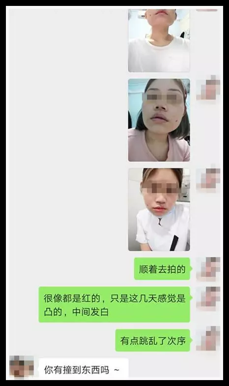 勿貪小便宜!找「微整師」整鼻,還附送「無痕酒窩」 ,結果她中招了!