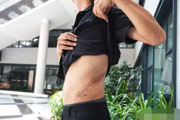 賣腎買iPhone!17歲高中生「剩一顆腎」7年後慘況曝光