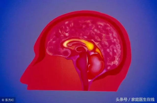 24歲男子因腦幹出血險死亡!不想腦出血,這個習慣趕緊戒掉!