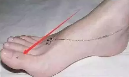 看看你身上這10處有痣嗎?只要有一個,恭喜你了,今生註定發達!